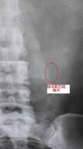 结石2.png